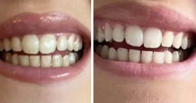 'Scientifically-proven' £20 teeth whitening solution hailed 'game-changer' for anyone wanting to erase 'decades of tea, coffee and fizzy drink stains' - www.manchestereveningnews.co.uk
