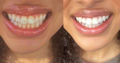 Shoppers flock to buy dentist-approved £20 teeth whitening solution claimed to erase years of tea, coffee and fizzy drink stains in 30-minutes - www.manchestereveningnews.co.uk
