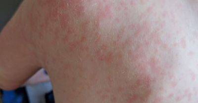 Measles outbreak: The lesser-known symptoms to be aware of before red rash develops - www.manchestereveningnews.co.uk - Britain