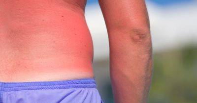 NHS tips for treating sunburn and when you should consider seeing a doctor - www.dailyrecord.co.uk - Scotland