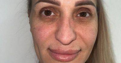 Woman heads to Turkey for surgery makeover – and is totally unrecognisable after - www.manchestereveningnews.co.uk - Turkey - city Istanbul